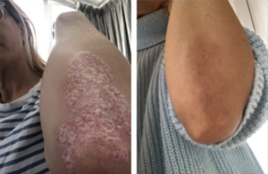 Ibolya Read Befoer and after soratinex photos
